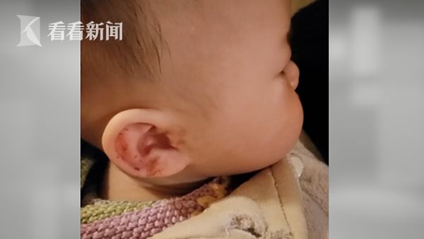 被老鼠咬伤要打狂犬疫苗吗,被老鼠咬伤后要不要打狂犬疫苗