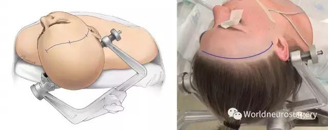 翼点入路的开颅要点,翼点开颅详解图