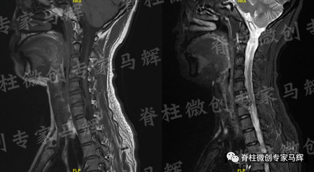 脊椎压迫神经做了微创术后腿麻疼,神经根损伤疼痛治疗