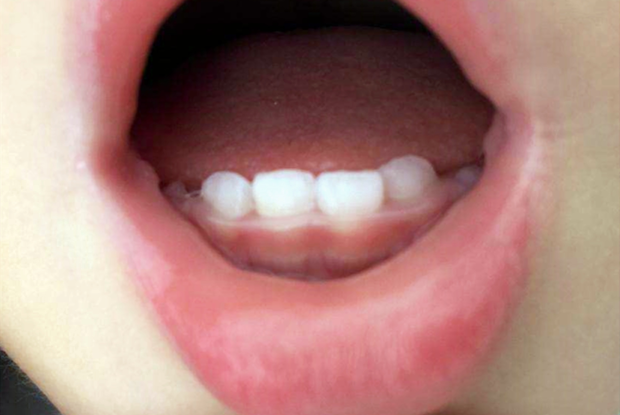 孩子补钙多了停止生长了怎么办,孩子经常补钙怎么还是长不高