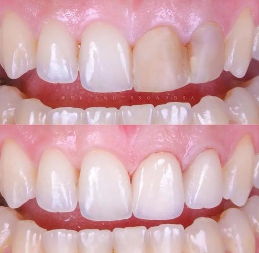 牙齿不漂亮做美容冠好还是矫正好,为了美牙去做根管治疗值吗