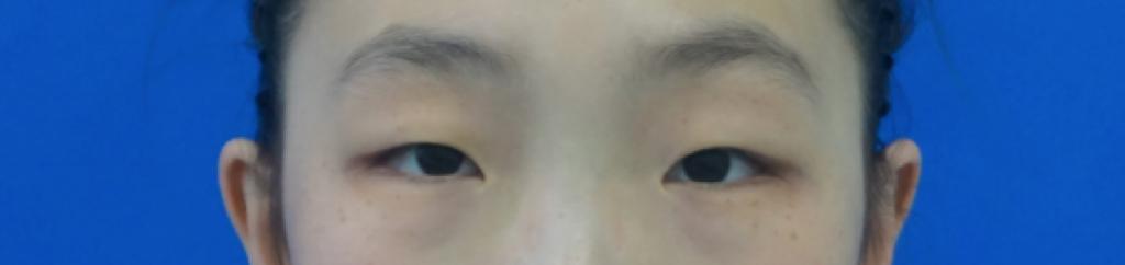 做双眼皮手术有风险呢,一般双眼皮手术价格表