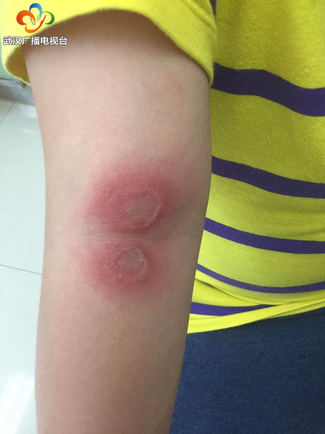 孩子身上有一条一条的痕迹痒,孩子身上感觉有虫子爬痒怎么回事