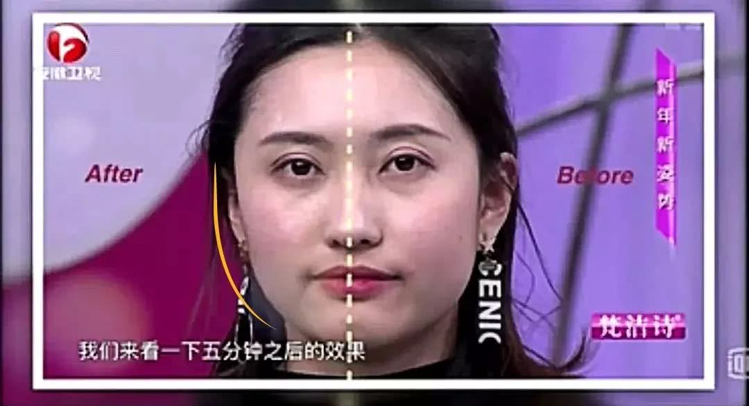 做了微整之后的感悟,微整经验