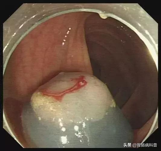 只要是肠息肉都要割掉吗,医生肠息肉切除后怎么处理伤口