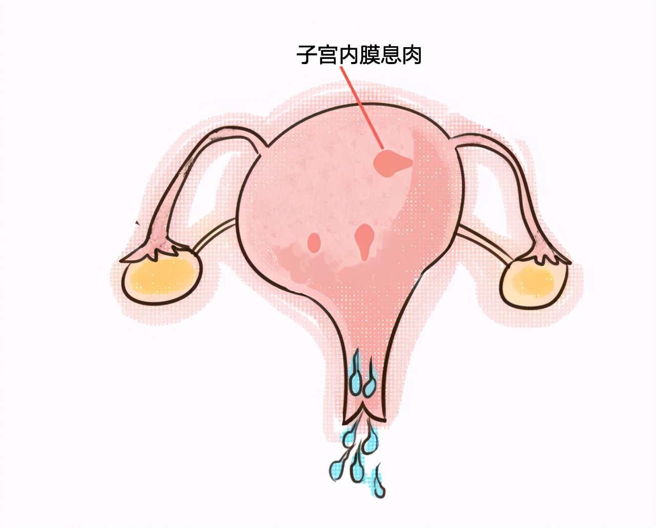 一直怀不上,竟是子宫内膜息肉在作怪?