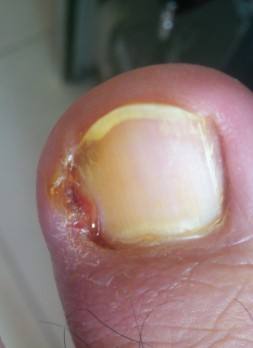 甲沟炎怎么办教你一招解决,甲沟炎怎么办用什么抗生素