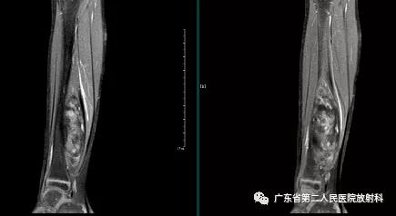 这个病例让我大涨知识：14岁男性右小腿痛性包块