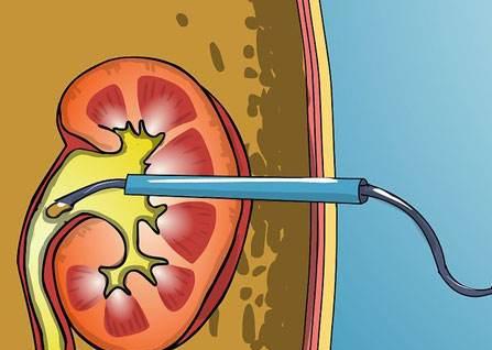 感染性结石会导致尿路持续感染吗,感染性结石用冲击波碎石好碎吗