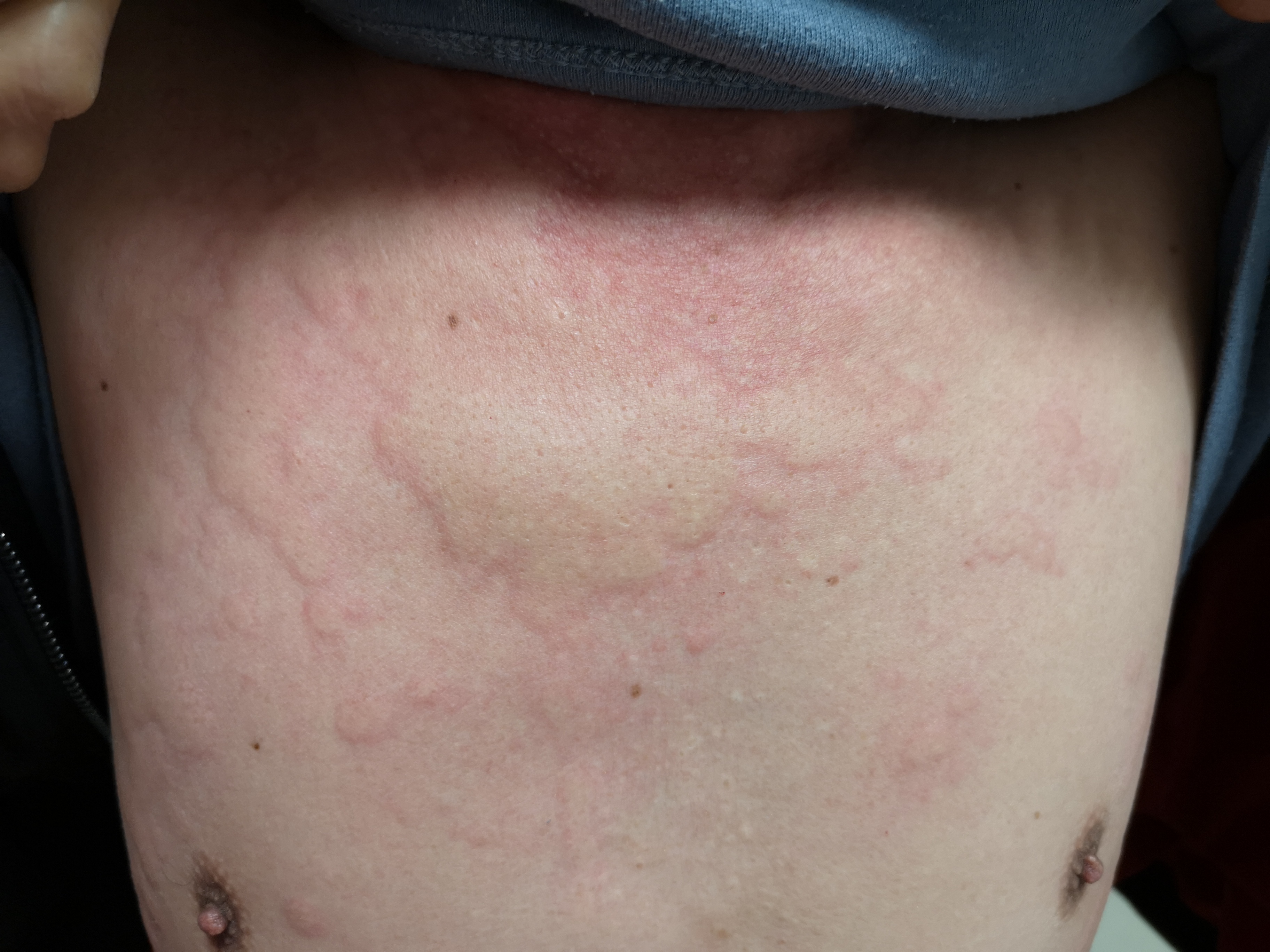 过敏原检测有没有用,过敏原检测麻烦吗