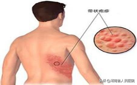 关于带状疱疹的7个错误认识,带状疱疹的十大误区