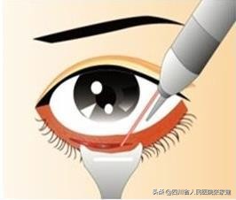 去眼袋手术各种后遗症怎么处理,祛眼袋手术有后遗症吗危险吗