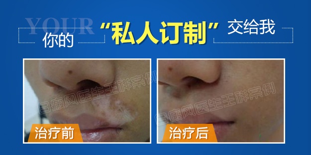 到底哪个国家治疗白癜风最好,中医治疗对称型白癜风