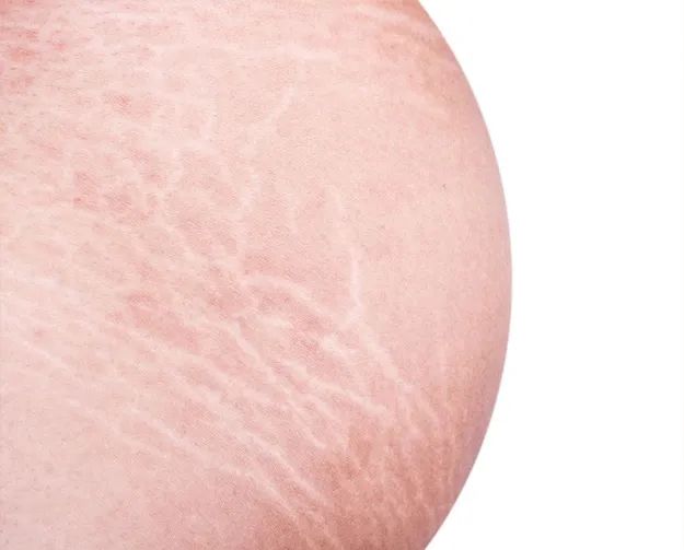 擦油真的能预防妊娠纹吗,预防妊娠纹的油是智商税吗