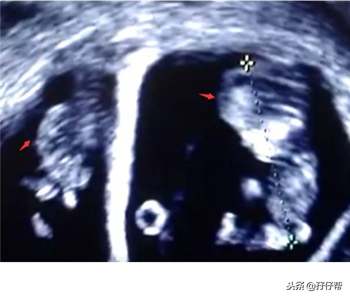怀孕10周双胞胎一个胎停了怎么办,怀孕10周双胞胎