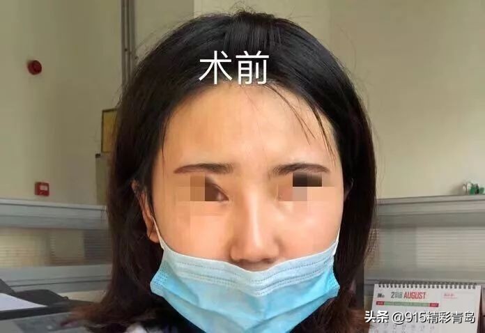 诺德整形医院失败案例,诺德整形鼻子