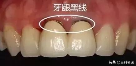 烤瓷白牙维持多长时间,做烤瓷白牙能管多久