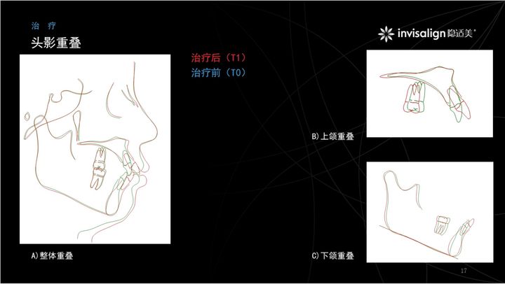 西安透明式牙齿矫正器龅牙,昆明牙齿矫正改变脸型