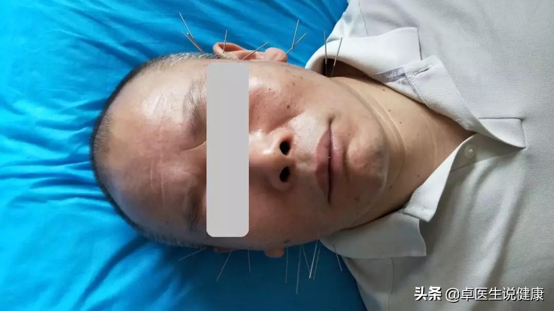 中医颊针案例分享:颈部包块20年,通过中医颊针疗法解决问题