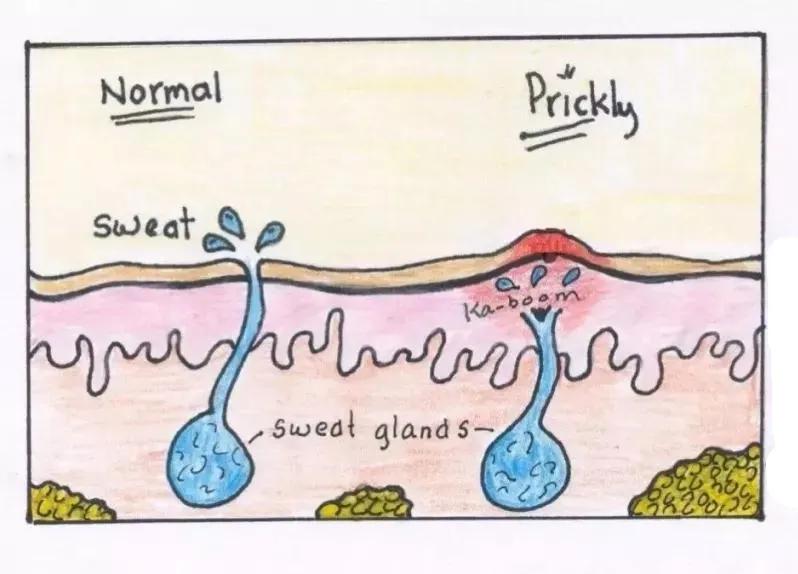 爽身粉去痱子,爽身粉止痒祛痱成人