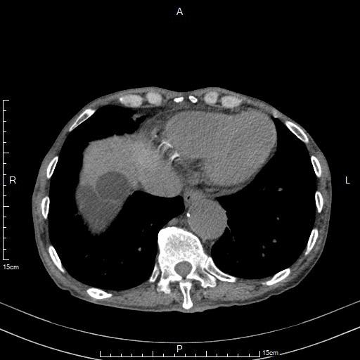 肝硬化肝囊肿要治疗吗,肝包虫囊肿与肝囊肿