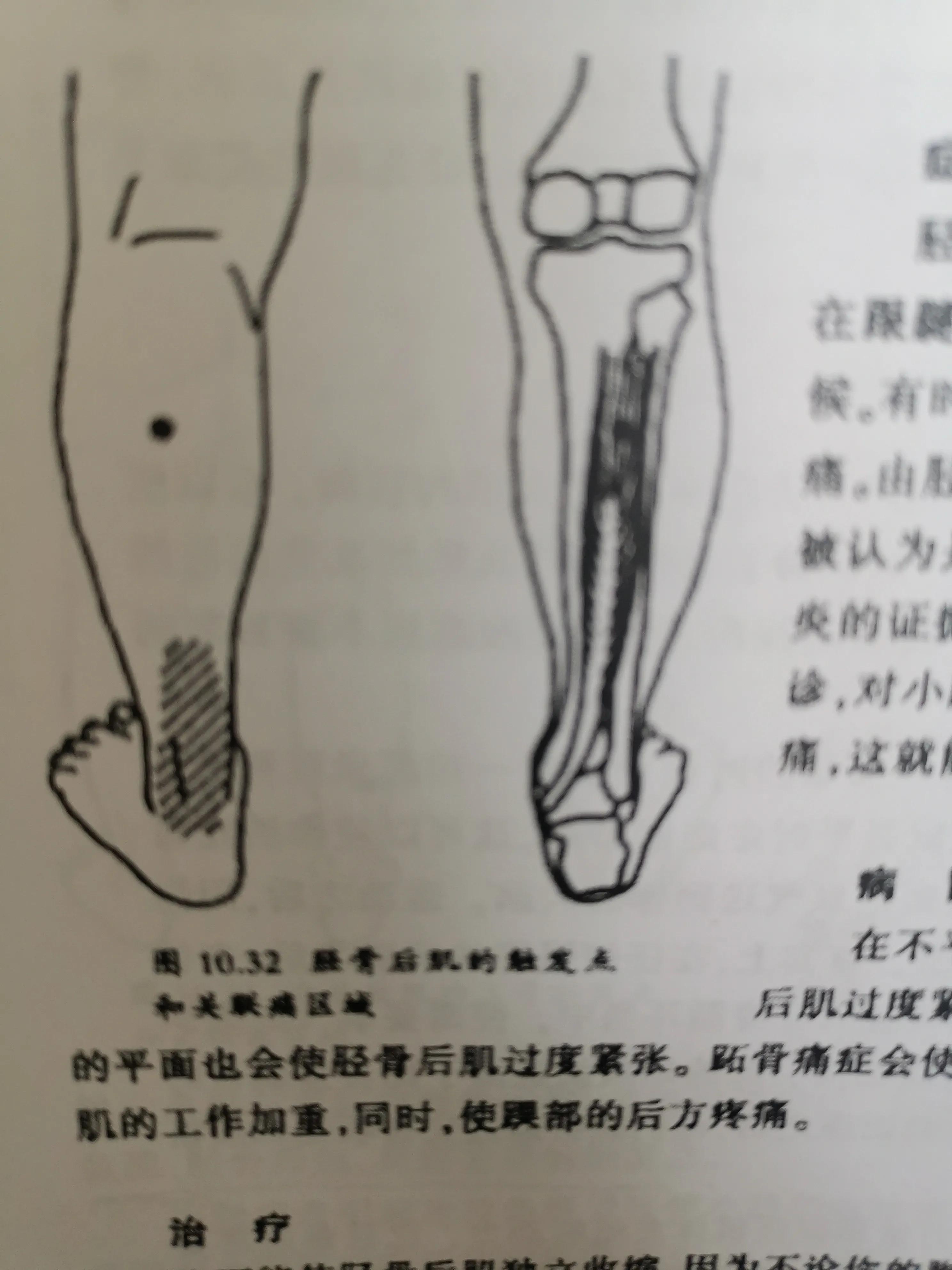 跟腱炎的自我治疗方法,跟腱炎最佳的物理疗法