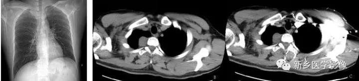 前上纵隔高密度影考虑胸腺未退化,肺纵隔胸腺结节12mm看什么科