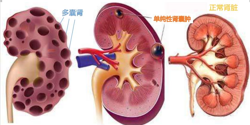 体检发现肾囊肿怎么办?医生告诉你最佳的应对方法