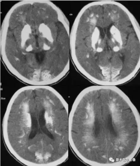 颅内有钙化怎么治疗,34岁脑部有钙化正常吗
