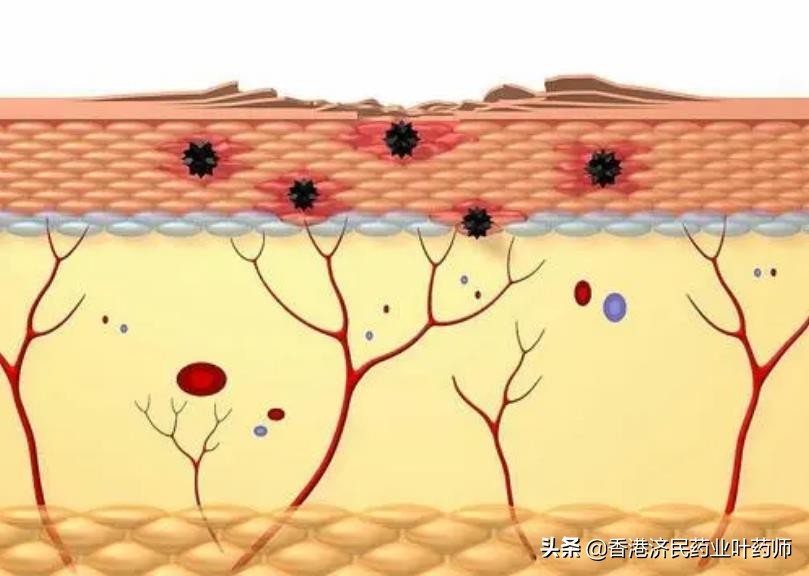 皮肌炎10%免疫球蛋白,皮肌炎新药有望治愈