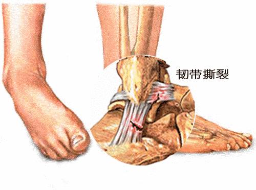 踝关节在崴脚是经常内翻还是外翻,经常崴脚怎么加强踝关节力量