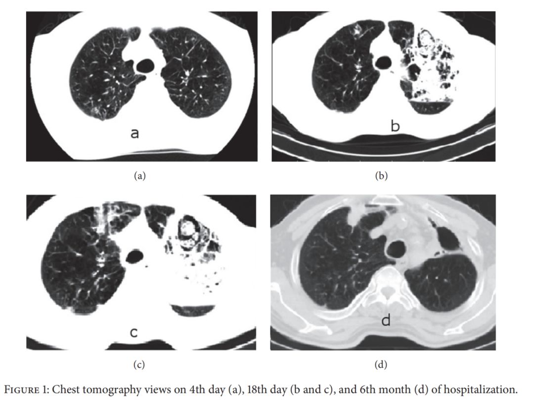 慢阻肺患者合并真菌感染,慢阻肺和真菌定植有关系吗