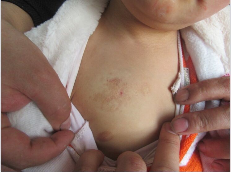 草莓状血管瘤注意事项,草莓状血管瘤婴儿什么时候能自愈