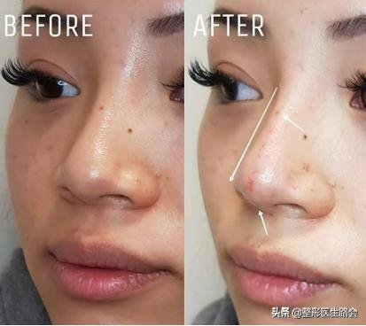 想去隆鼻,隆鼻到底值不值得入手