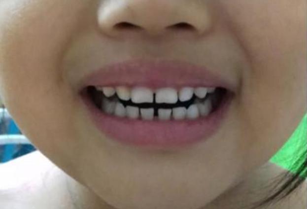 五岁宝宝牙缝越来越大,9岁孩子戴牙套的痛苦经历