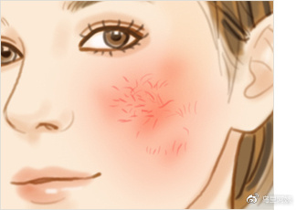 红血丝敏感肌肤怎么修复小妙招,自己去除高原红血丝最有效的方法