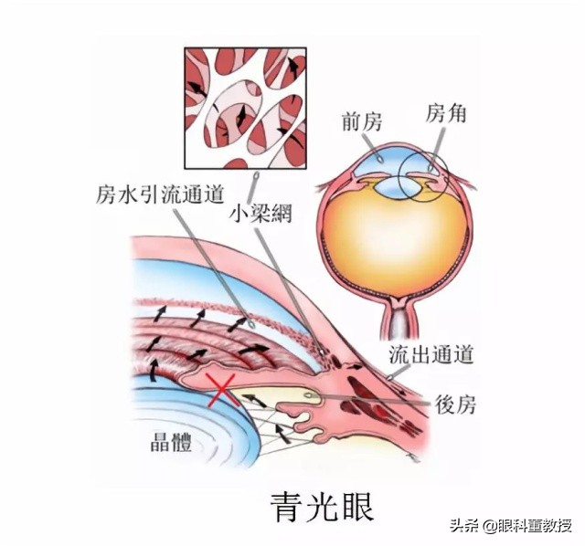 浙二眼科青光眼专家哪个好,青光眼能治好吗