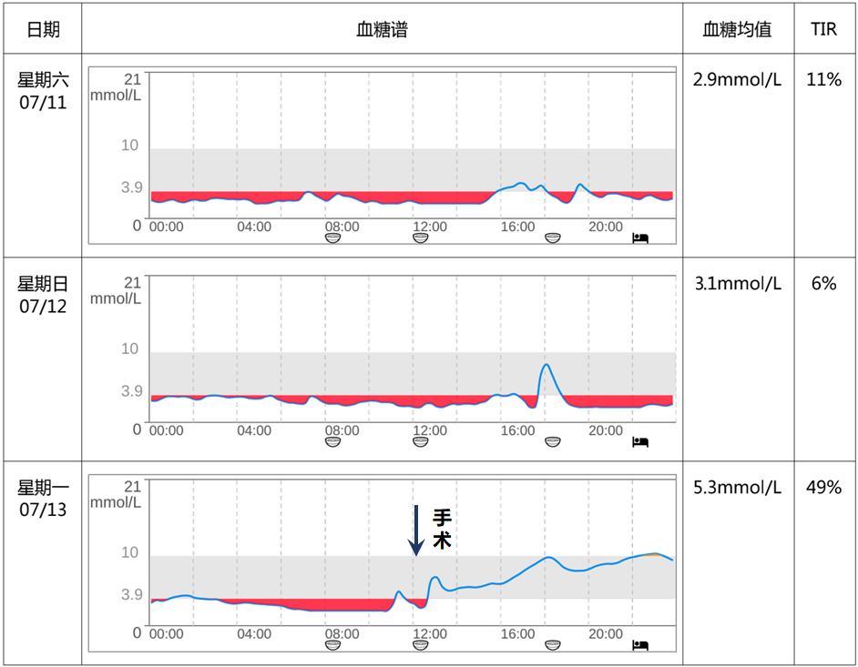反复低血糖是肿瘤吗,读报反复低血糖警惕胰岛素瘤