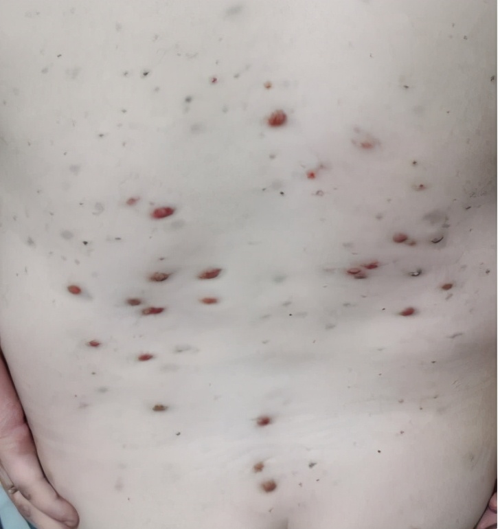 病例分享｜银屑病8年患者，采用中药调理，半个月就见好转