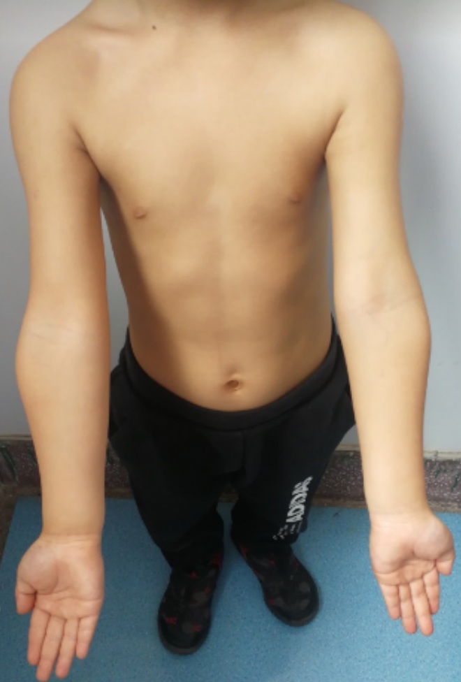 肘关节骨折出现的后遗症,肘关节陈旧性骨折肘内翻