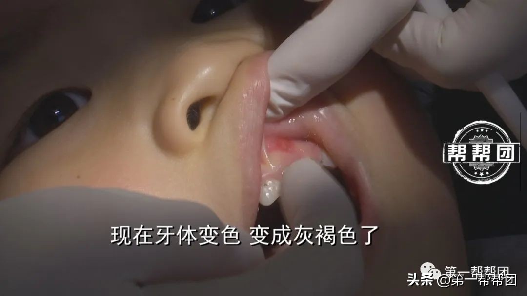 小孩牙齿烂掉牙龈有脓包,5岁女童牙龈反复化脓