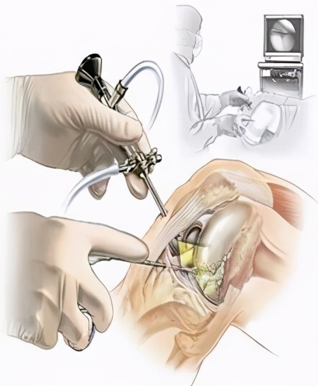 膝骨关节炎只能“换关节”?看看关节外科大夫如何“保膝”