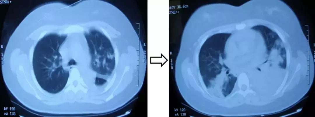 呼吸道感染的诊断和鉴别诊断,感染性监测存在的问题