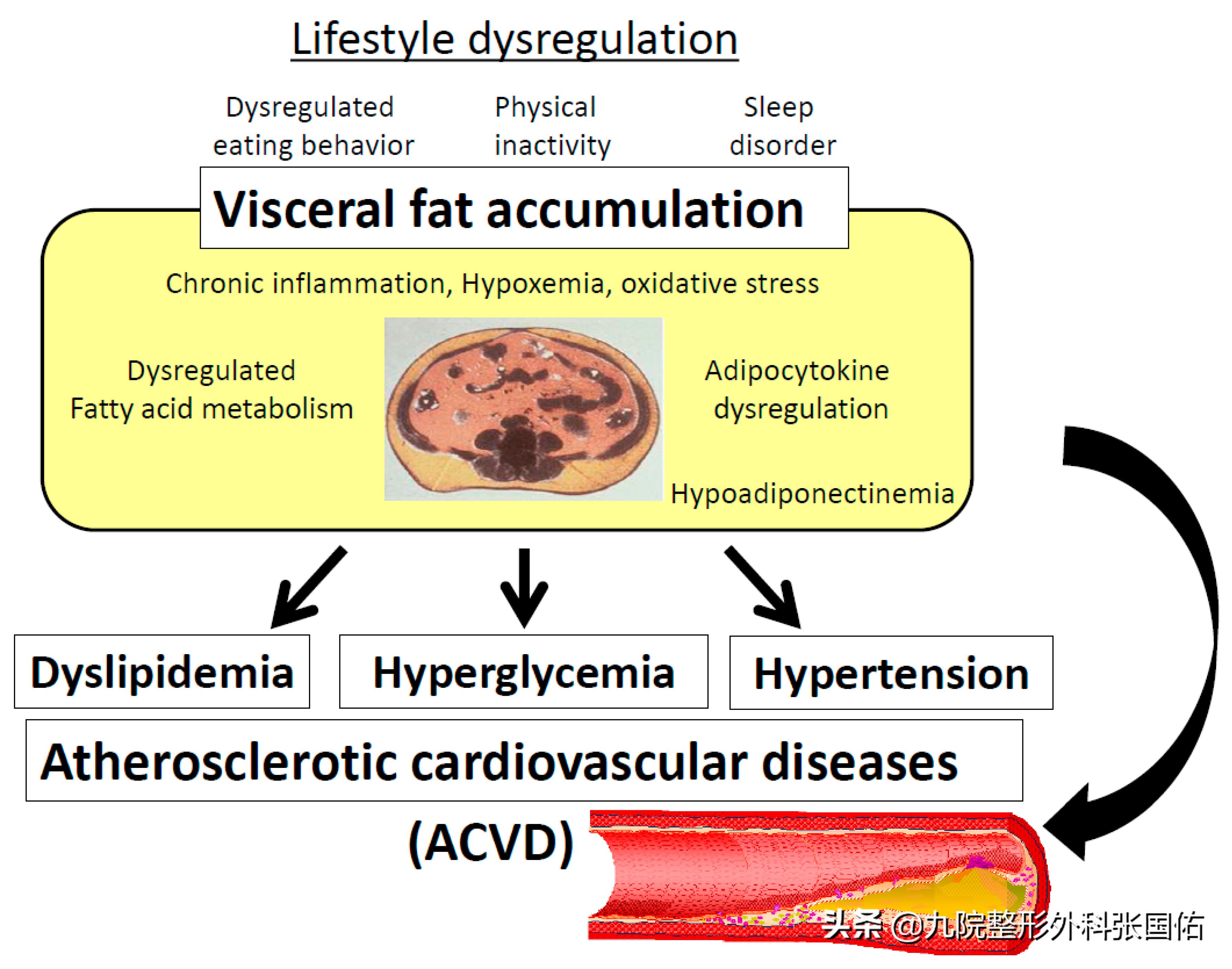 肥胖型大肚子的表现,肥胖大肚子是怎么引起的