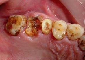 镶牙之前必须要拔掉残根吗？残根该怎么处理？牙科专家来解疑