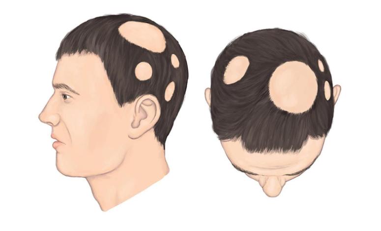 揭秘斑秃真相4大病因不可不知,关于脱发斑秃病因你知多少