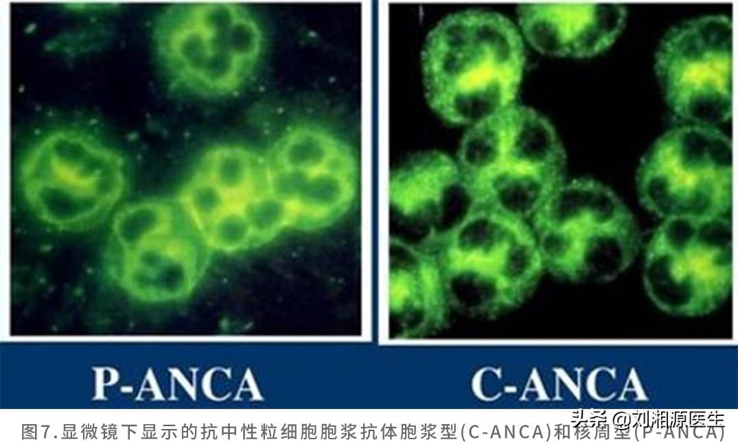 「免疫相关不良妊娠答疑解惑40」——系统性血管炎