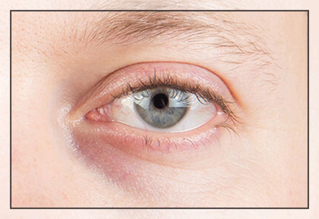 董氏奇穴一针治疗黑眼圈,熊猫针一针就能去掉黑眼圈吗