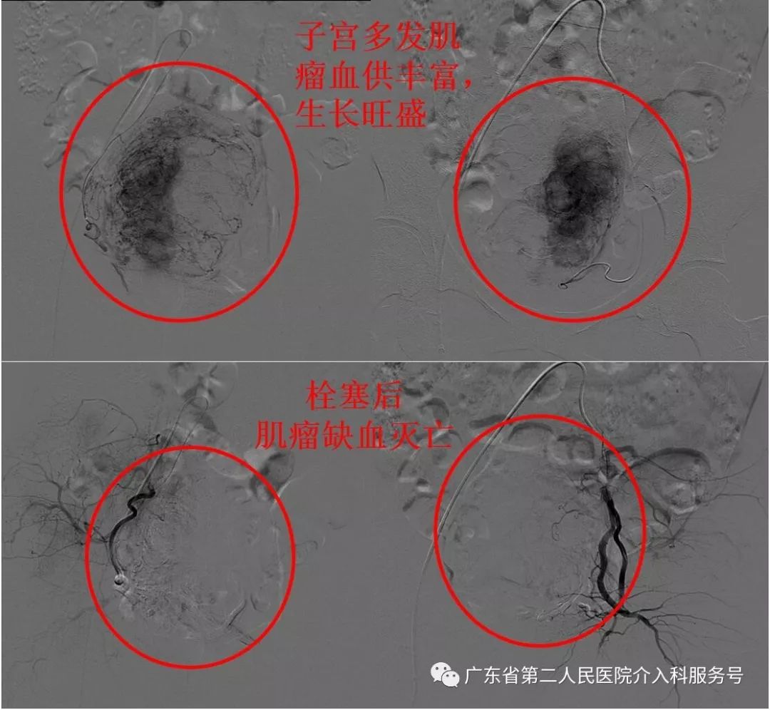 子宫肌瘤引起月经量多贫血怎么办,子宫多发肌瘤月经量多怎样治疗