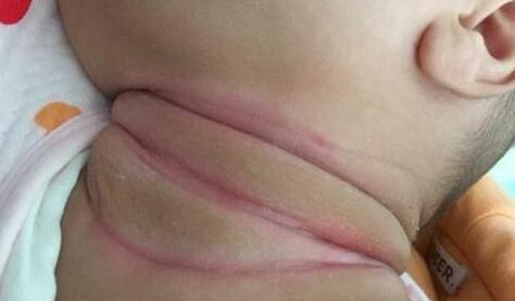 宝宝淹脖子哭闹不止，竟是奶奶惹的祸，这种错误别再犯了